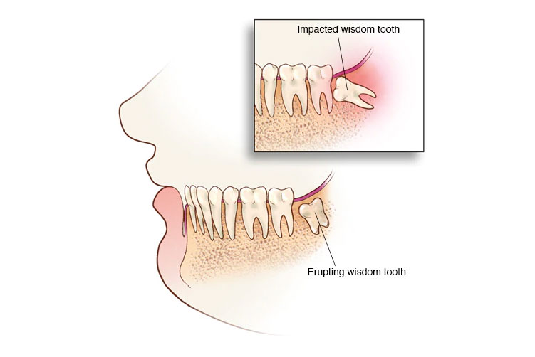 Impacted Wisdom Teeth